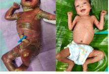 सुदूर बीजापुर में चिकित्सा चमत्कार : अत्यंत दुर्लभ बीमारी से जूझते शिशु को बचाया….