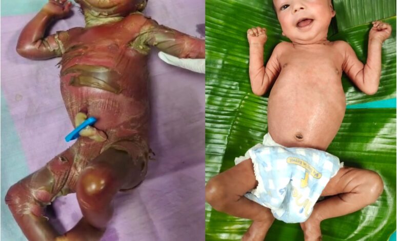 सुदूर बीजापुर में चिकित्सा चमत्कार : अत्यंत दुर्लभ बीमारी से जूझते शिशु को बचाया….